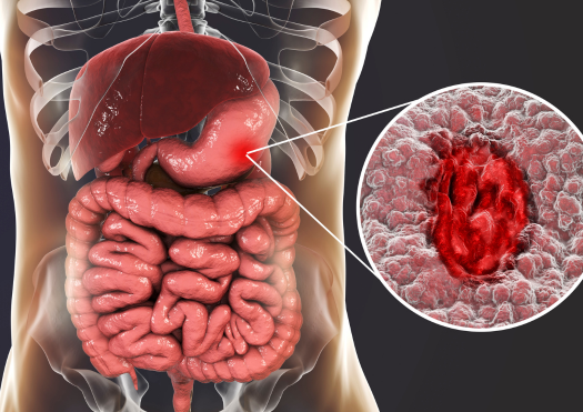 Gastritis & Ulcer Diseases